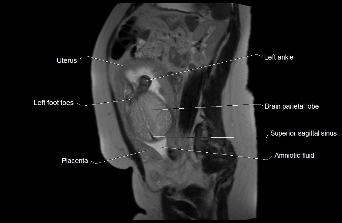 MRI fetal anatomy sagittal image 25.webp